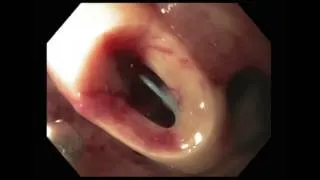 Endoscopic Rescue of Dislodged Trans-Abdominal Decompressive Esophagostomy Tube