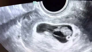 Take a Peek!  Ultrasound of a triple sac pregnancy at 8 weeks, continuing as twins!