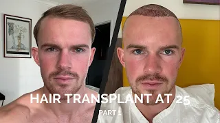 My Journey to a Hair Transplant at 25 Years Old
