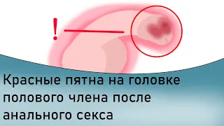 Красные пятна на половом члене после анального секса.