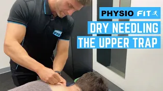 Dry needling the upper trap