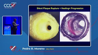 Understanding Coronary Atherosclerosis-Pedro R  Moreno, MD