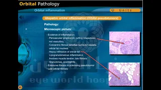 orbital inflammation