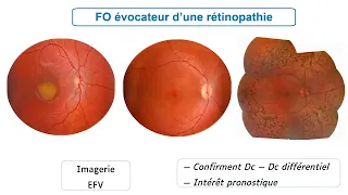 Les maladies rares de la rétine et du nerf optique un après midi d’informations pour les patients