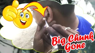 BIG White Ear Plug Removed from Ear Canal ASMR / Most Satisfying Ear Cleaning with Rain Sounds