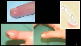 Felon - finger pulp infection