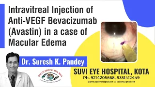 Intravitreal Injection of Anti-VEGF Bevacizumab (Avastin) in a case of Macular Edema.mpg