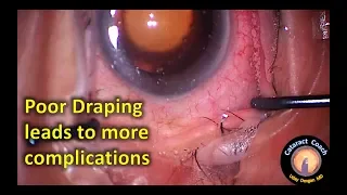 Poor draping leads to complications with Capsulorhexis during Cataract Surgery