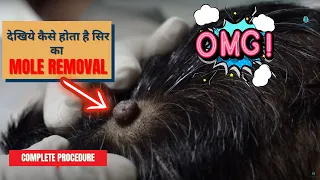 Live Mole removal Surgery  | Best Mole removal in Delhi | Laser treatment for mole | Dr. Jangid