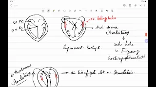 Alles über Wolff Parkinson White Syndrom mit EKG-Beispiele