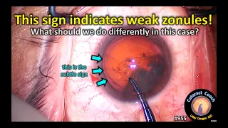 this subtle sign indicates weak zonular support in cataract surgery