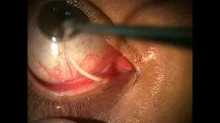 Masterika Stent Removal in the clinic