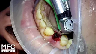 Одномоментная имлантация. One stage dental implant surgery. 一期種植牙手術。