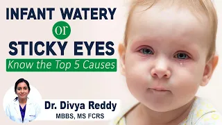 INFANT WATERY OR STICKY EYES || Baby Watering Eyes Causes and Treatments || Best Vision Eye Hospital