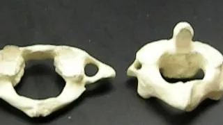 Cervical vertebrae: Atlas & Axis