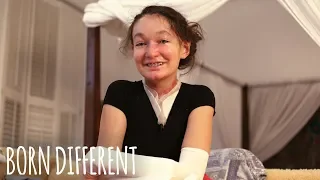 The Teenager With Butterfly Skin | BORN DIFFERENT