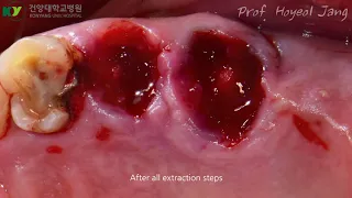 Atraumatic Extracton & Immediate Implant Placement Surgery