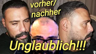 Haartransplantation 7 Monate Vorher Nachher😱(Gencay)