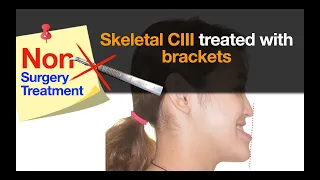 Skeletal Class III with nonsurgical treatment｜【Chris Chang Ortho】CC733