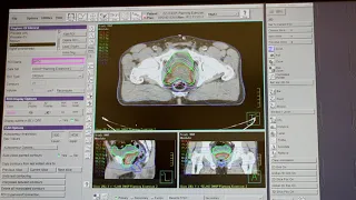 Radiotherapy Planning