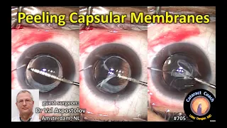 capsular membrane peeling in cataract surgery cases