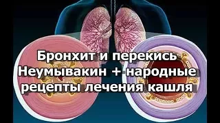 Бронхит и перекись - Неумывакин + народные рецепты лечения кашля