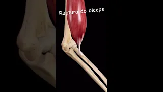 #ortopediaetraumatologia #ortopedista #biceps  Ruptura do biceps e suas perdas!