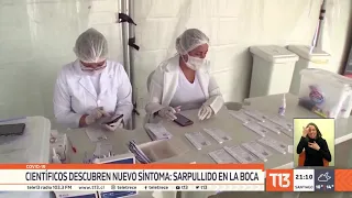 Científicos españoles encuentran nuevo síntoma del COVID-19: Sarpullido en la boca