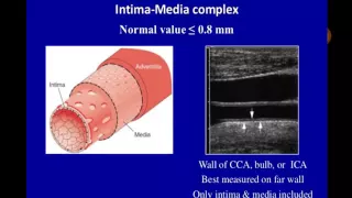 Carotid duplex  Dr Ahmed Baz In Arabic