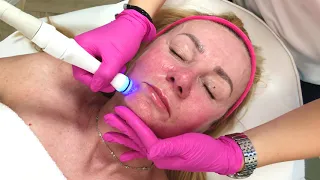 Jak wygląda zabieg Aquapure w Soft Skin Dermaclinic?