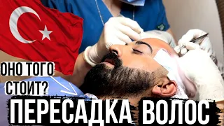 Пересадка волос в Турции ВСЯ ПРОЦЕДУРА ОТ и ДО!