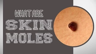 What are Skin Moles?