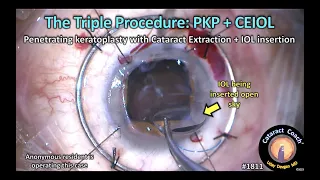 CataractCoach™1811: the triple procedure: penetrating keratoplasty cataract surgery