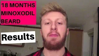 18 Months Of Minoxidil Results - For Beard Growth