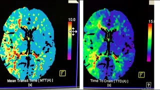 Video 1 of 3:  How to interpret a Brain CT Perfusion Scan for acute stroke