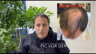 Haartransplantation bei Elithair - 10 Monate Post OP Tonsur & 14 Monate Post OP im vorderen Bereich