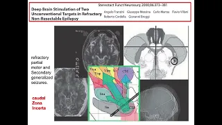 Epilepsy, DBS and controversies by Marwan Hariz