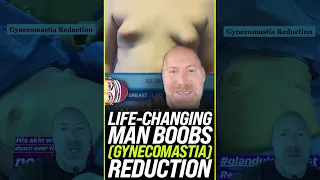 Life-Changing Man Boobs Transformation 😱 #shorts
