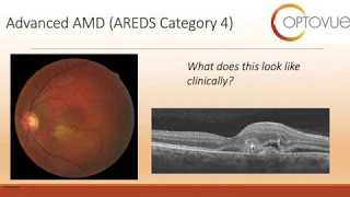 How to Interpret OCT in AMD