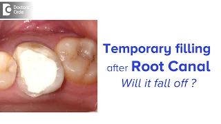 How long can you keep a temporary filling after root canal? - Dr. Chandan Mahesh