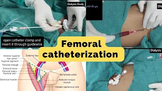 Hemodialysis Femoral IJV Catheterization Procedure! Non USG Guidance