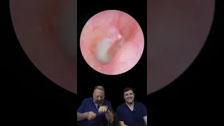 IRRIGATION OF A CHUNKY EAR WAX PLUG - EP843