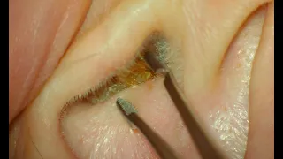 Keratosis Obturans : EAR WAX REMOVAL : 4K HD