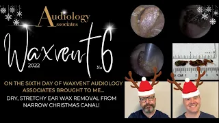 DRY STRETCHY EAR WAX REMOVAL FROM NARROW CANAL - EP691