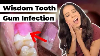 what does this SWOLLEN gum flap mean? (Pericoronitis Explained)