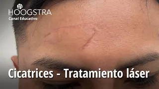 Cicatrices - Tratamiento láser - 22261