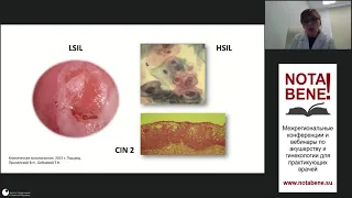 30.04.2021. Т.Н. Бебнева "Предраковые заболевания шейки матки. Читаем кольпоскопические картины..."