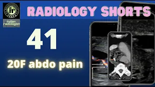 20F WITH ABDOMINAL PAIN || CT & MRI ABDOMEN || PANCREATIC MASS