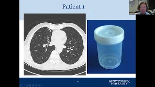 Update on Bronchiectasis Treatments Including new Investigational Therapies