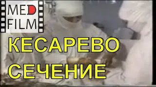 Кесарево сечение - экстраперитонеальное © Extraperitoneal cesarean section